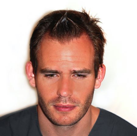 Hairline example photo